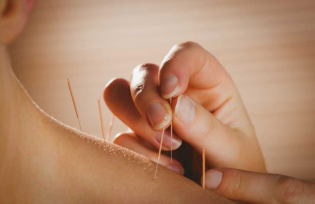 I 5 benefici dell’Agopuntura: un prezioso alleato nella Terza Età 